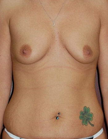 Abdominoplasty