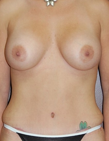 Abdominoplasty