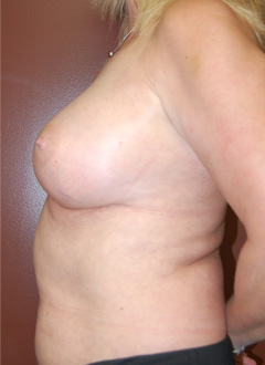 Breast Augmentation