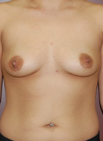 Breast Augmentation