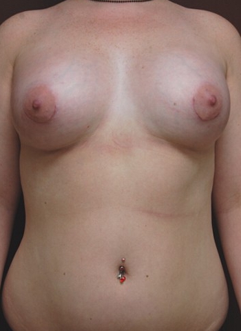 Breast Augmentation