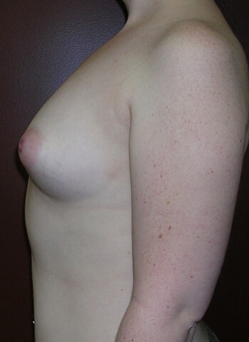 Breast Augmentation