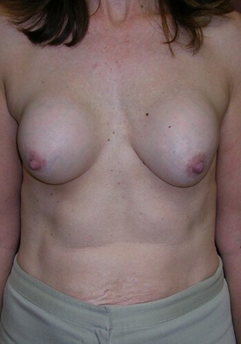 Breast Revision