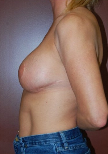 Breast Revision