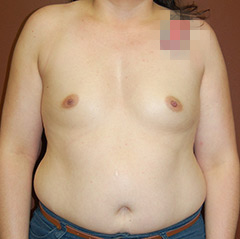 Breast Augmentation