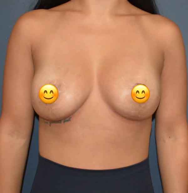 Breast Revision