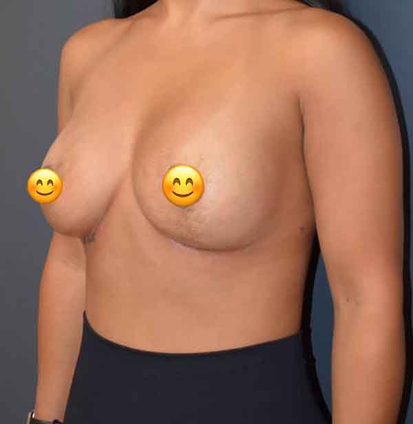 Breast Revision