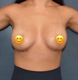 Breast Revision