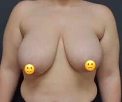 Breast Reduction