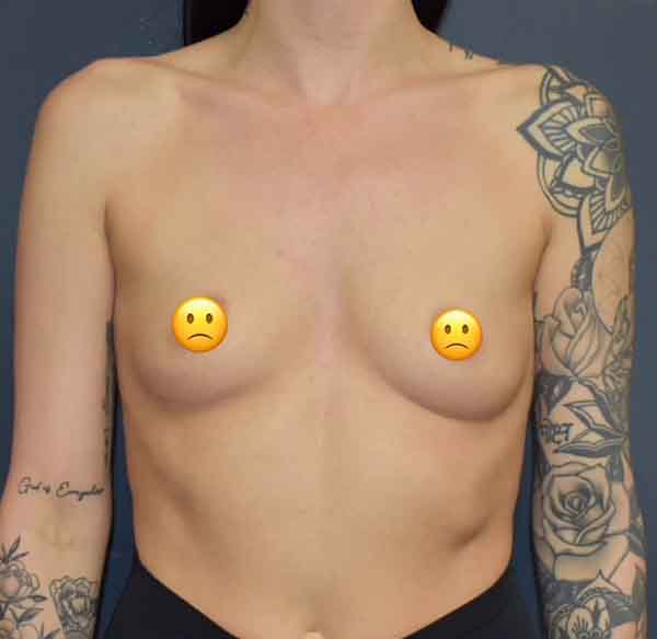 Breast Augmentation