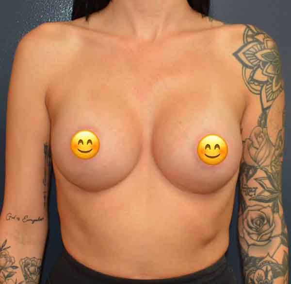 Breast Augmentation