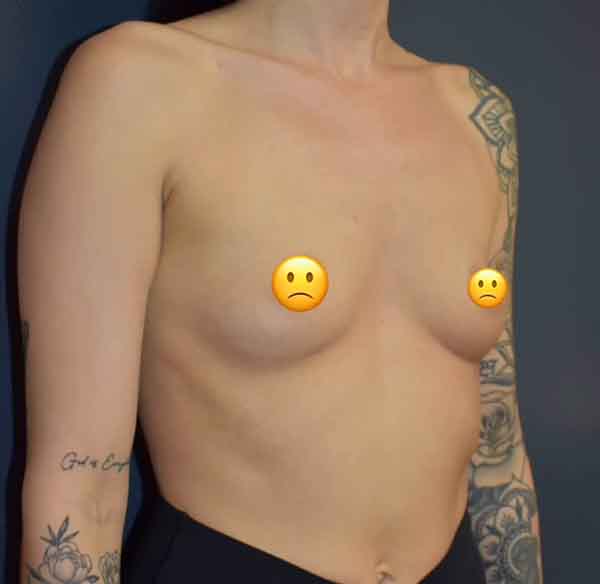 Breast Augmentation