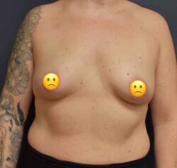 Breast Augmentation