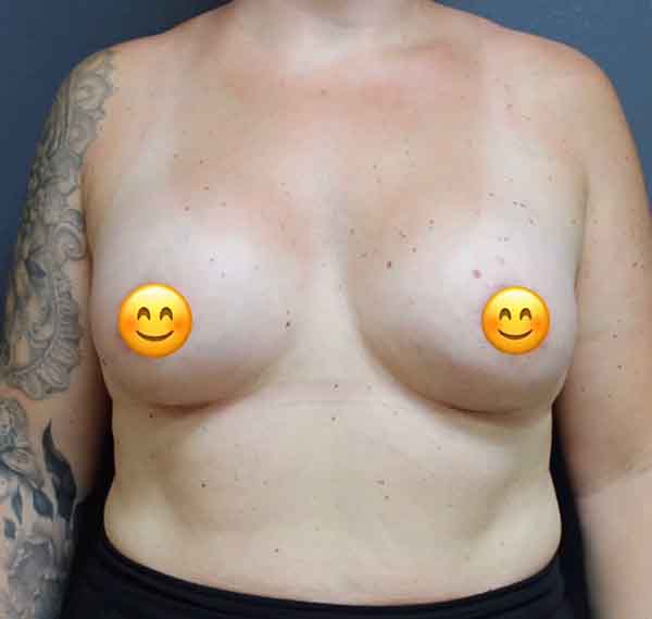 Breast Augmentation