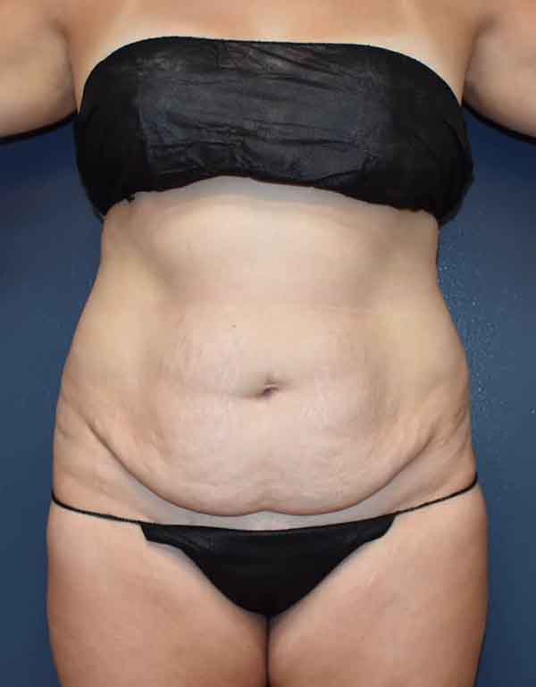 Abdominoplasty