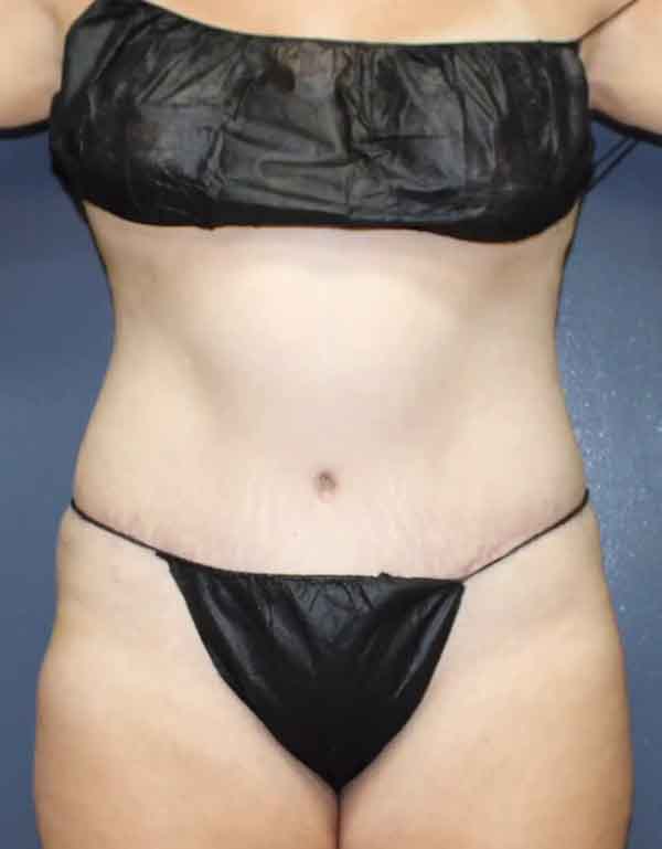 Abdominoplasty