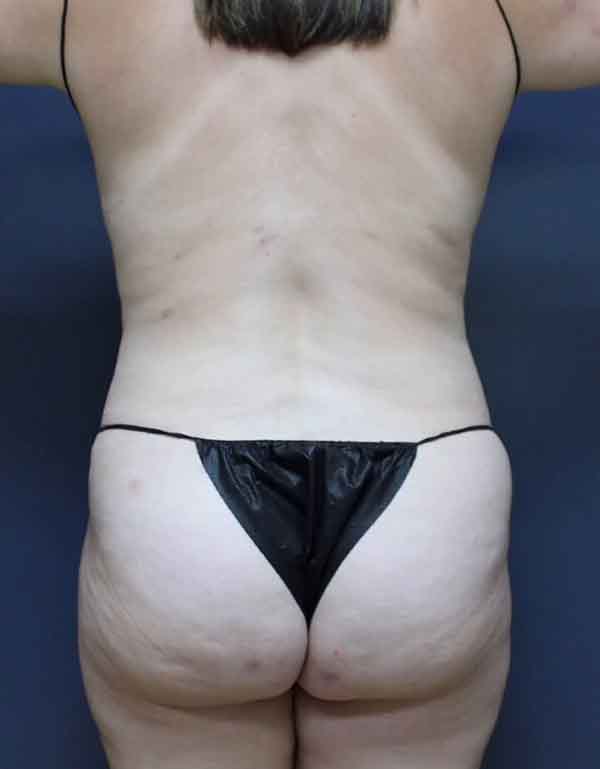 Abdominoplasty