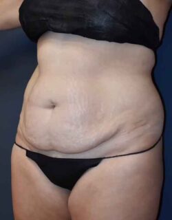 Abdominoplasty