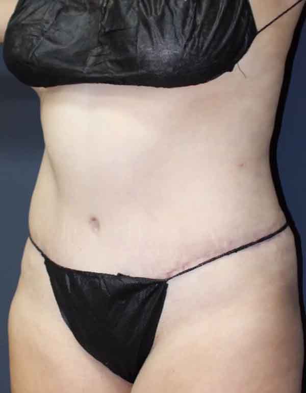 Abdominoplasty