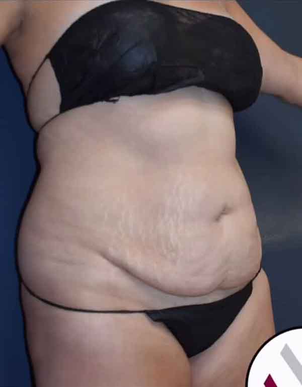 Abdominoplasty