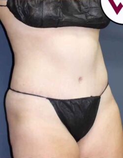 Abdominoplasty