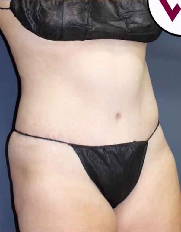 Abdominoplasty