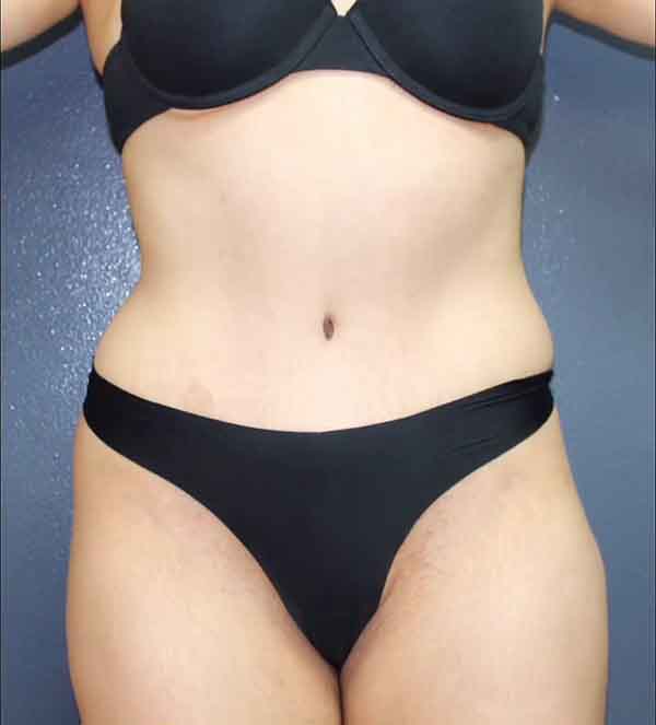 Abdominoplasty