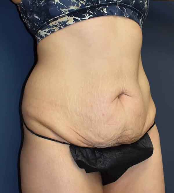 Abdominoplasty