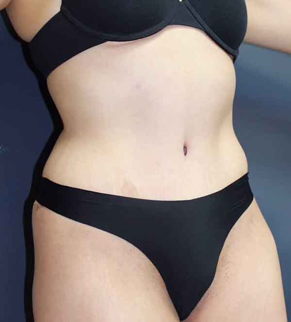 Abdominoplasty