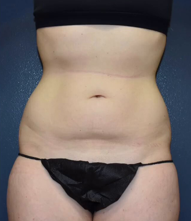 Abdominoplasty