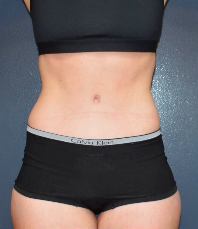 Abdominoplasty