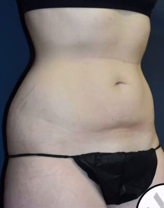 Abdominoplasty