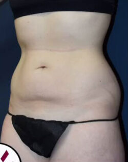 Abdominoplasty