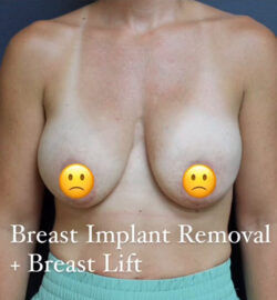 Breast Lift