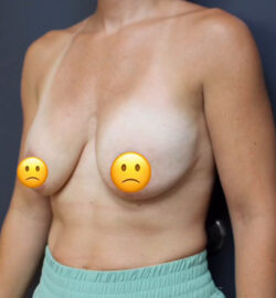 Breast Lift