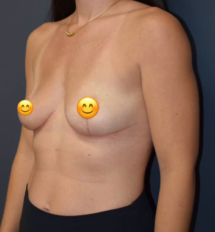 Breast Lift