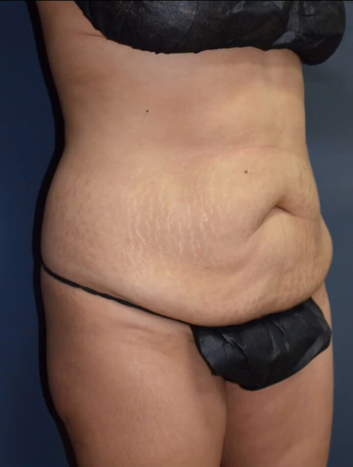 Abdominoplasty