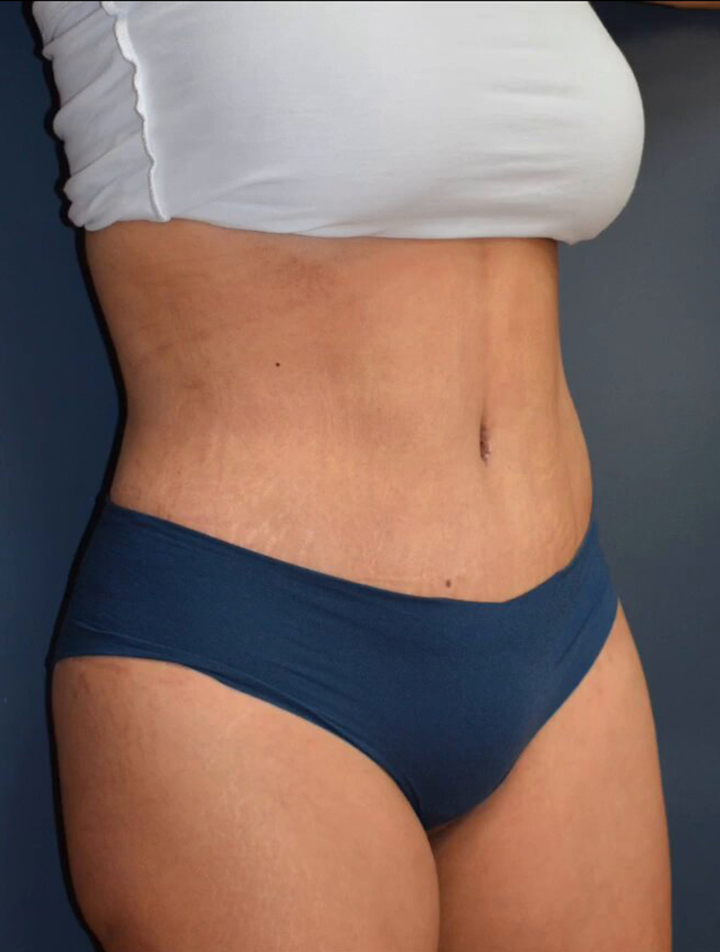 Abdominoplasty