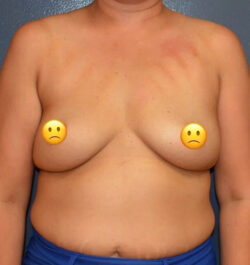 Breast Augmentation