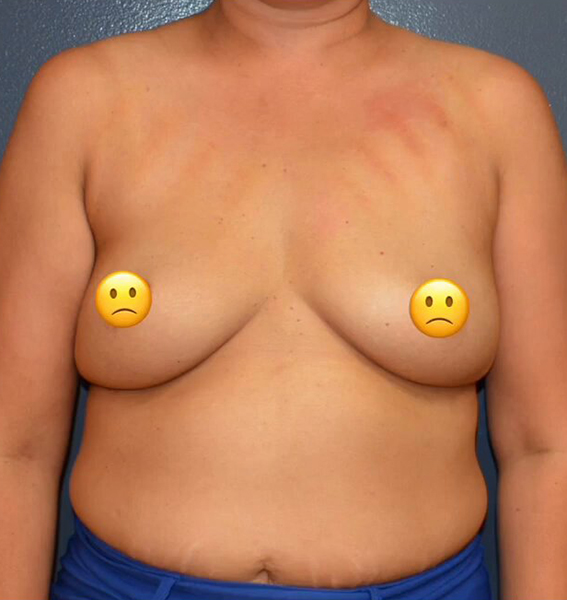 Breast Augmentation