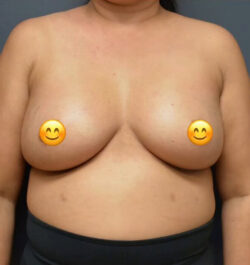 Breast Augmentation