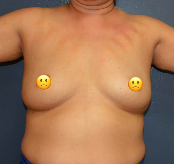 Breast Augmentation