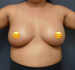 Breast Augmentation