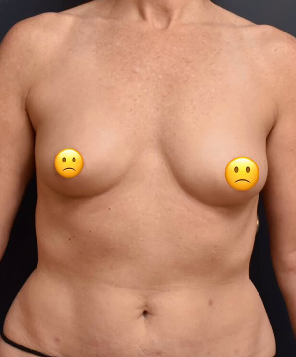 Breast Augmentation