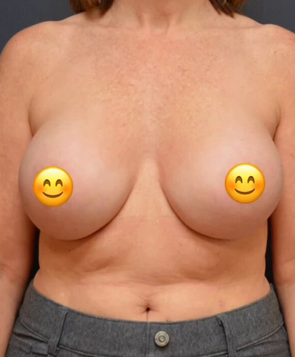 Breast Augmentation