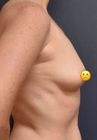 Breast Augmentation