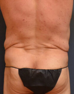 Abdominoplasty