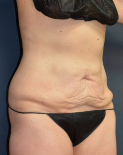 Abdominoplasty