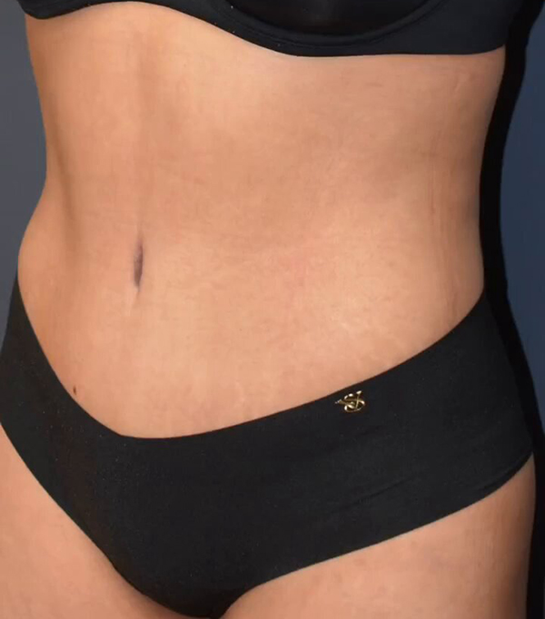 Abdominoplasty