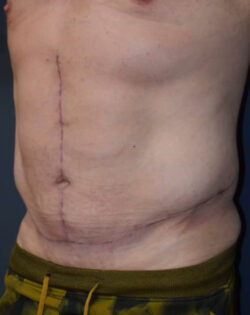 Abdominoplasty